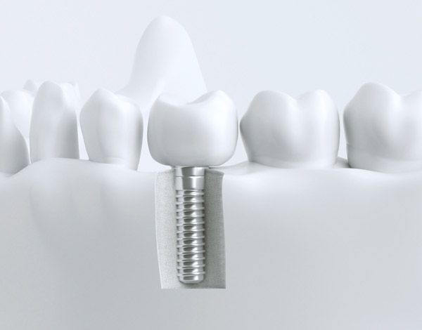 Oralchirurgie & Implantologie